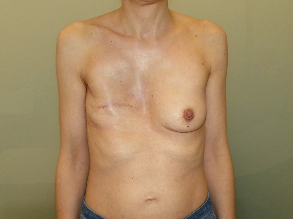 Breast Cancer Patients Going Flat After Mastectomy