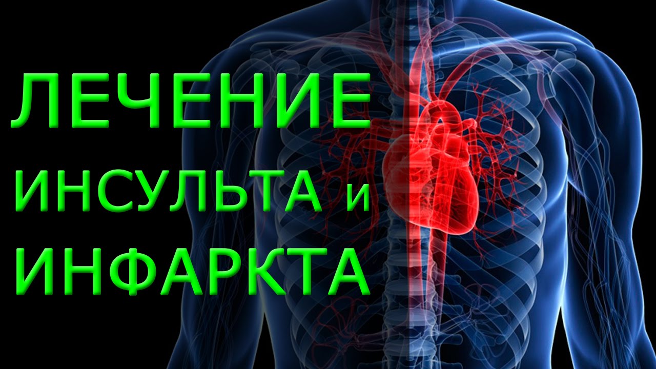 Лечение инсульта и инфаркта в домашних условиях. Профилактика инсульта ...