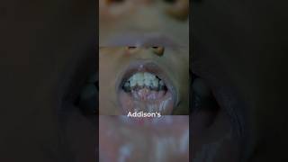 Explained The Connection Between Low Cortisol In Addisons Disease And Hyperpigmentation