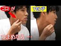 "脂肪吸引とバッカルファット除去の違いって何？"☆なぐら先生の質問コーナーvol.4☆
