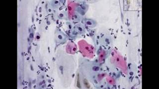 Histopathology Cervix --Low grade squamous intraepithelial l