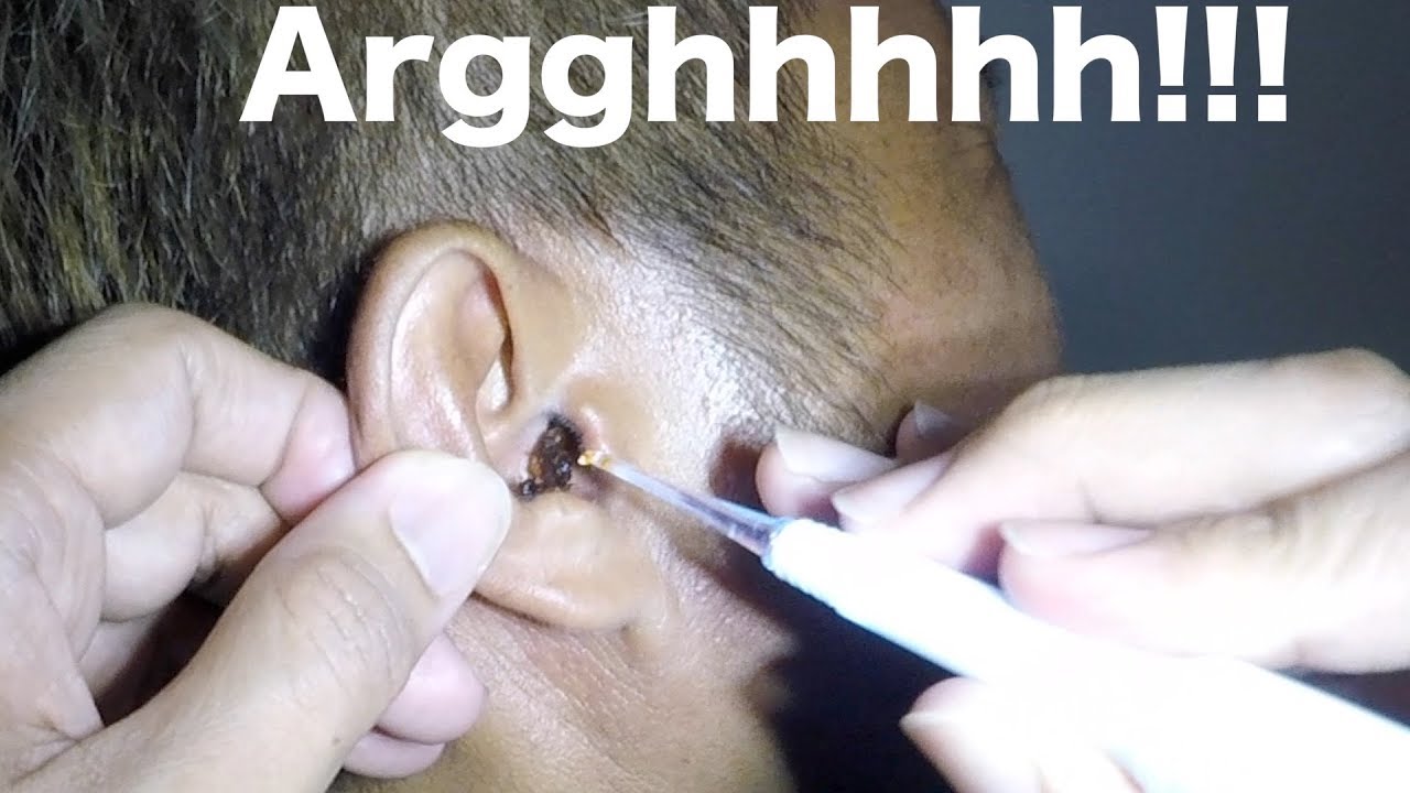 Epic Earwax Removal using Lighted Ear Curette YouTube