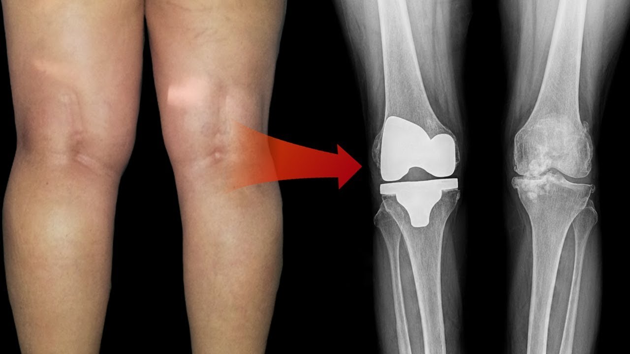 How To Treat A Bakers Cyst Behind The Knee Top 5 Home Remedies For