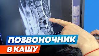 Можно Ли Полностью Вылечить Спину После Перелома 3-Х Позвонков?