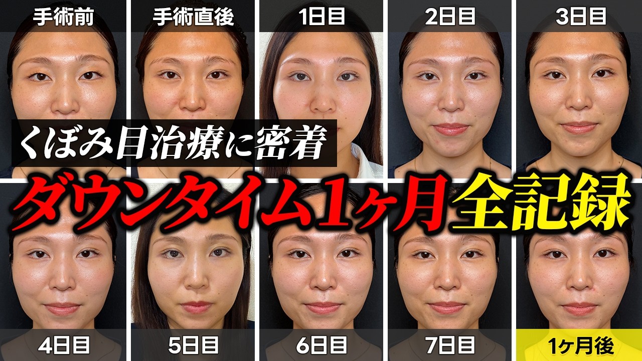 Sunken Upper Eyelids] Rejuvenate and Improve Hollow Eyes That Make