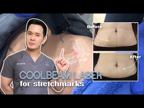 Video: Biaya Penghapusan Laser Stretch Mark