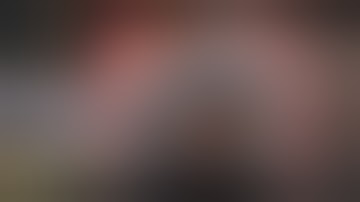 IOL Exchange for Intrascleral Haptic Fixation Yamane Lens Fixation