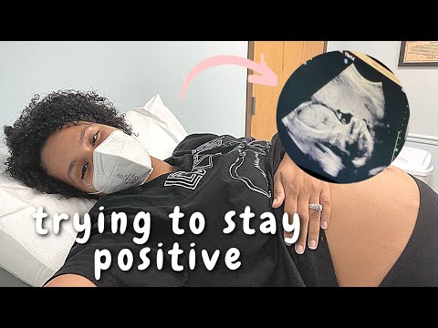 My BABY has a Choroid Plexus Cyst | 20 WEEK ANATOMY SCAN