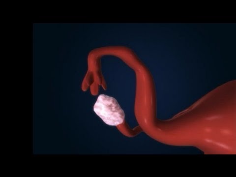 Vídeo: Como reverter a esterilização Essure: 11 etapas