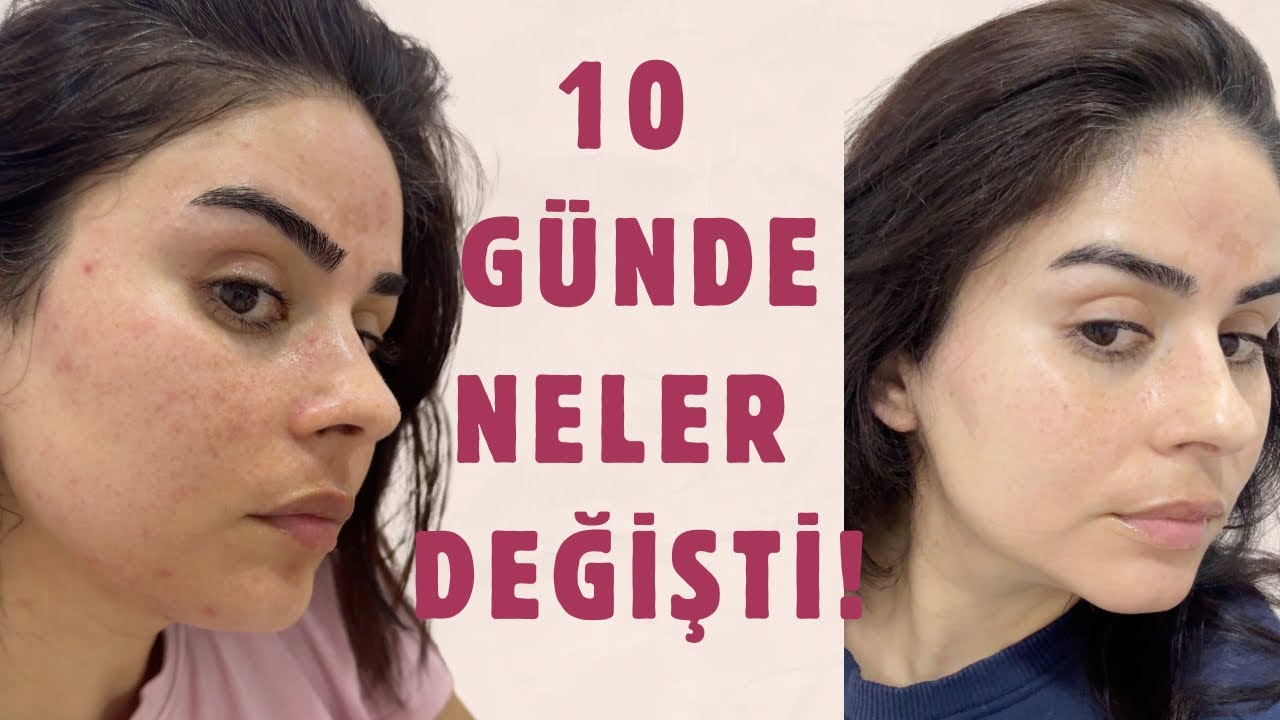 BUNU BENDE BEKLEMİYORDUM : EN İYİ PDRN ÜRÜNÜ HANGİSİ ?