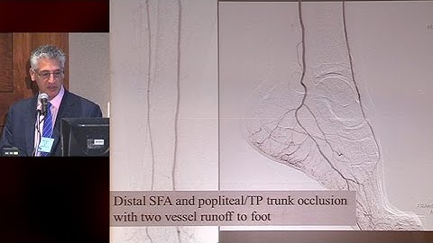 Anatomic Staging for Chronic Limb Threatening Ischemia