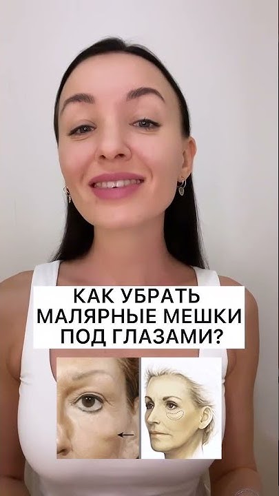 Как убрать малярные мешки под глазами - YouTube