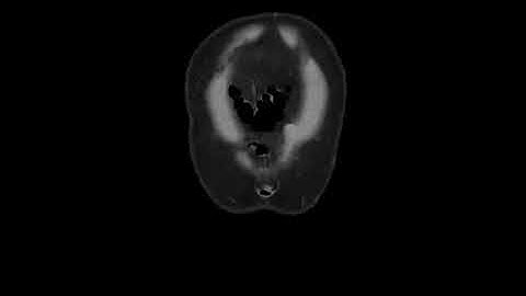 Pseudomembranous colitis - C Difficil colitis - coronal CT reformat