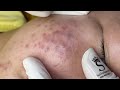 Blackheads And Pimples | Điều Trị Mụn Tuổi Dậy Thì - SacDepSpa #349