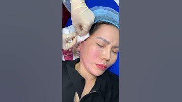 Cấy chỉ nâng cơ giúp da săn chắc #vivaline #skincare