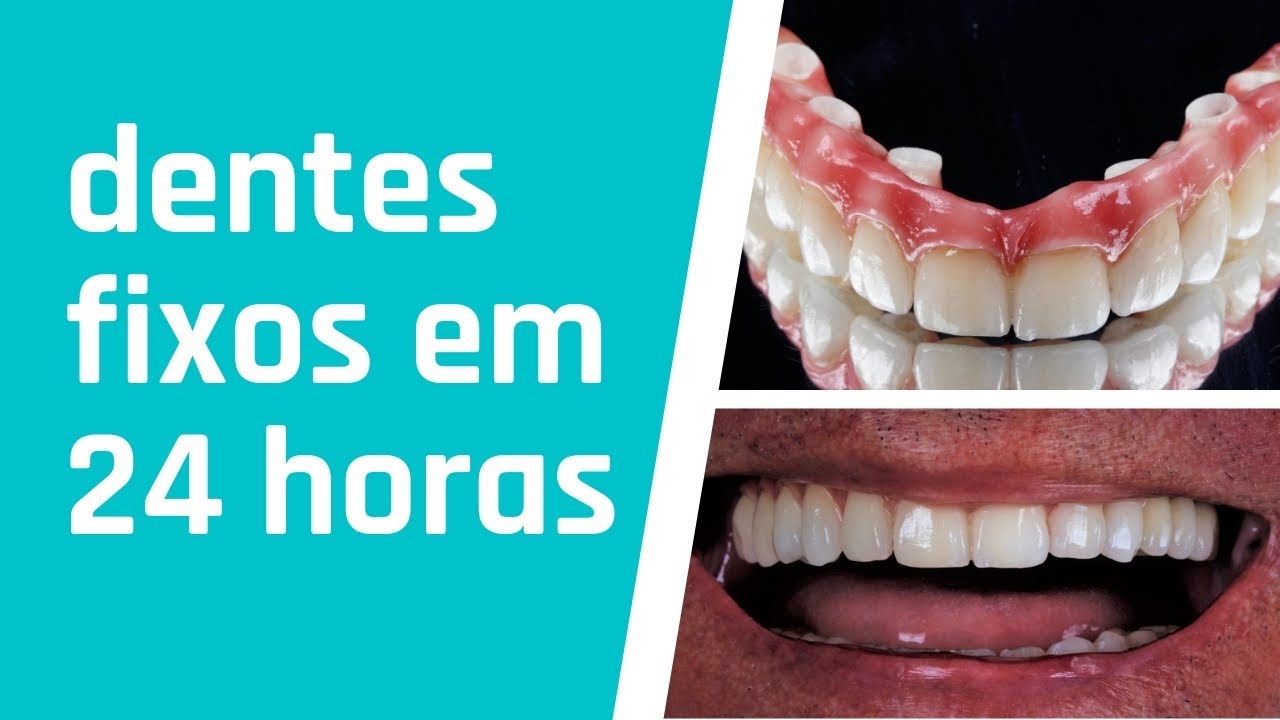 VEJA A PRÓTESE PROTOCOLO NA ARCADA INFERIOR E FOTOS DE CASOS DO CONSULTÓRIO