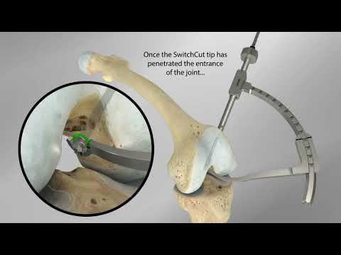 Vídeo: Què és la reconstrucció d'acl al·lograft?