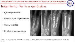 Osteosíntesis con tornillos endomedulares en fracturas de metacarpianos