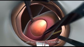 Inguinal Hernia Repair