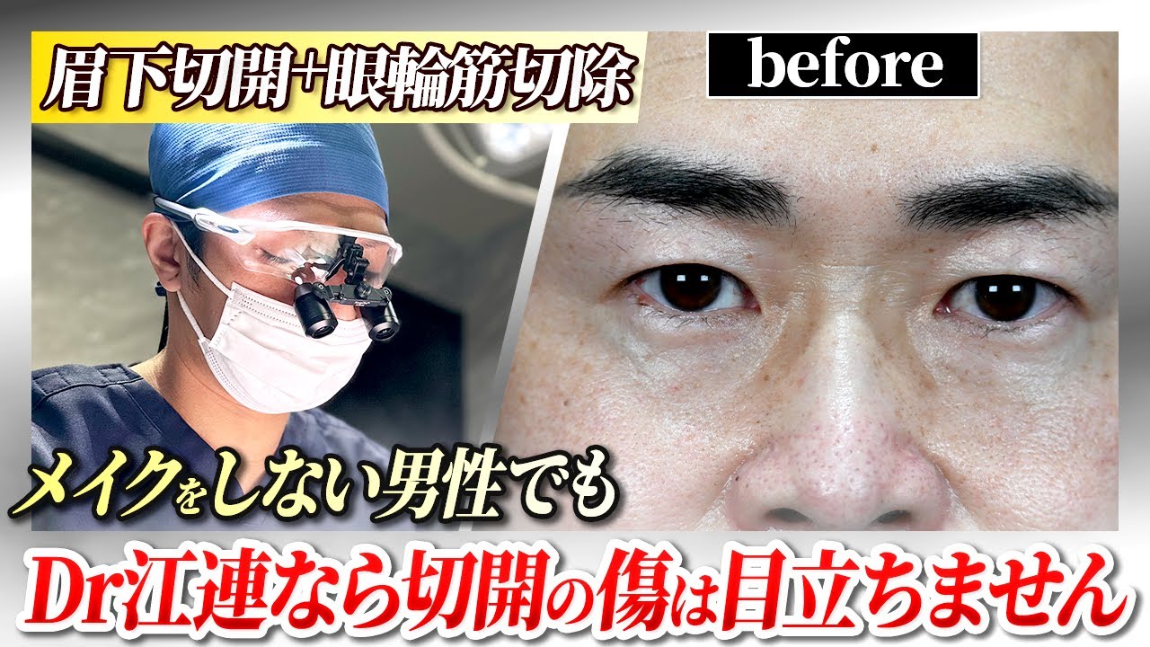 Case Explanation] Before and After of Brow Lift + Orbicularis