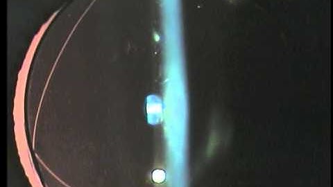 Capturing a Rotating Toric IOL