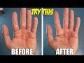 HOW TO GET RID OF HAND CALLUSES AND TREAT THEM