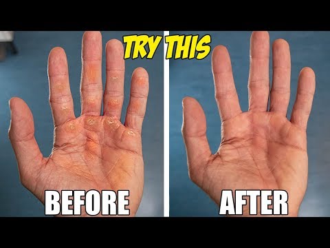 Video: How To Remove Excess On Your Hands