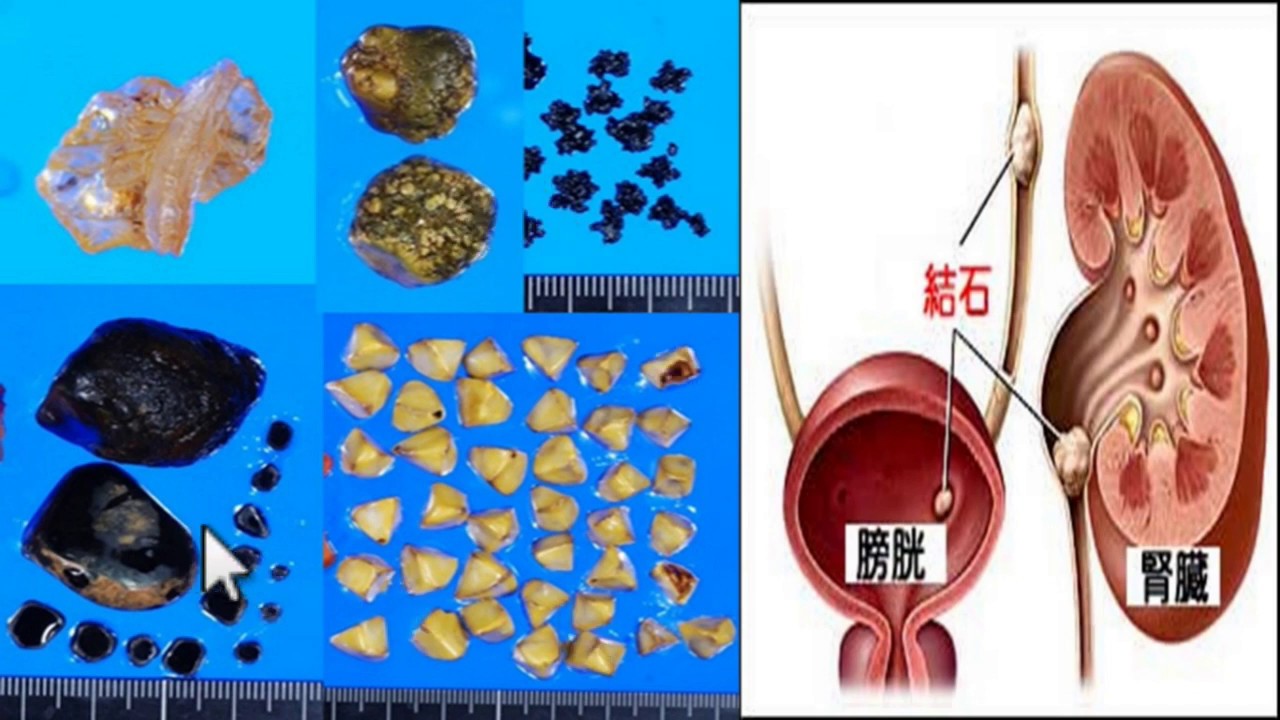 腎臓結石、その特定方法と予防方法を学ぶ