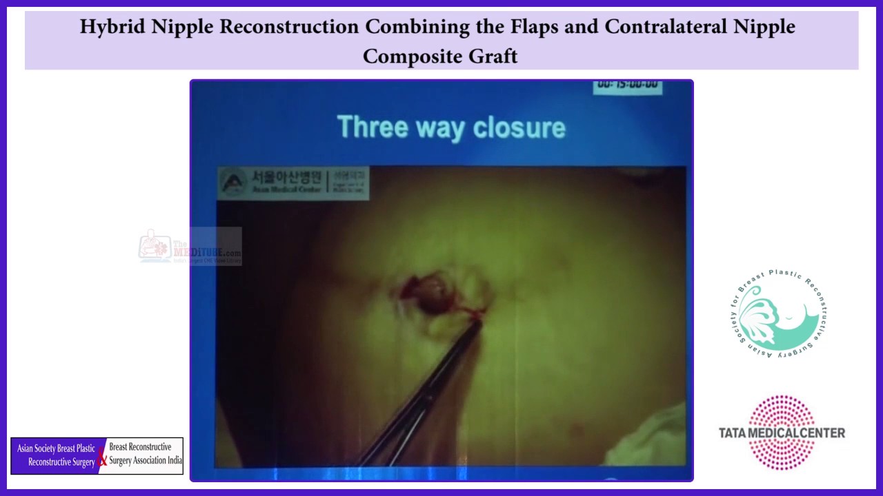 50 Hybrid Nipple Reconstruction Combining the Flaps and Contralateral