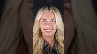 Composite Bonding Smile Makeover