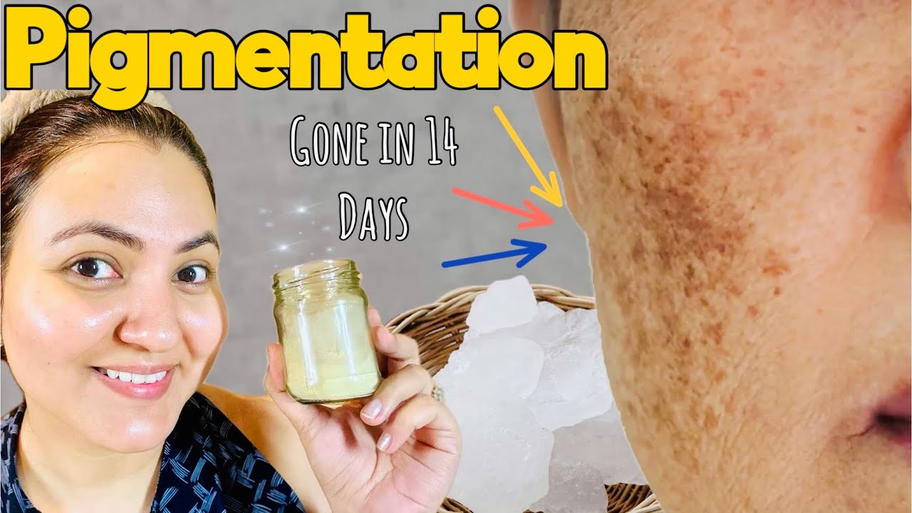 World's Best Remedy For Pigmentation & Dark Spots @preityprerna
