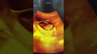Twin pregnancy- CRL #pregnant #ultrasound #shorts