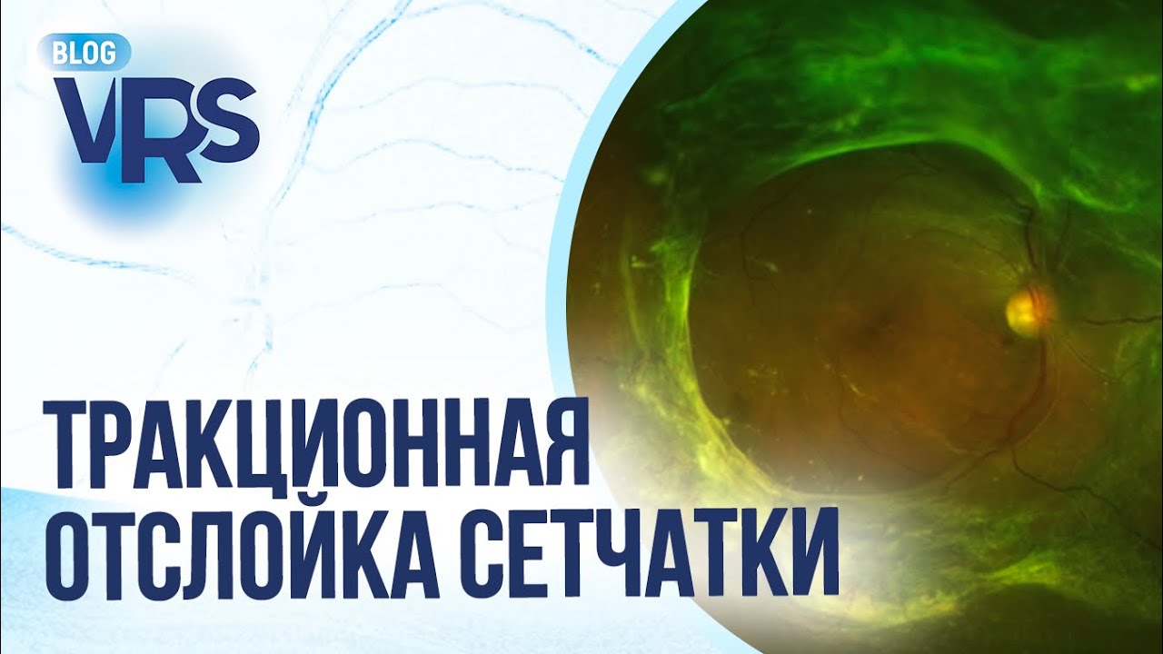 Сахарный диабет / Диабетическая ретинопатия / Тракционная отслойка сетчатки / Макулярный разрыв