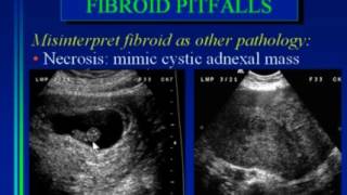 Pitfalls in Gynecologic Ultrasound