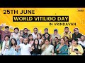 25th june 2022 world vitiligo day celebration in vrindavan  aarus foundation  udtaakash