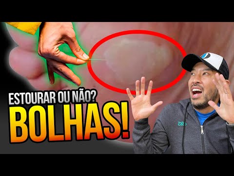 Pode ESTOURAR BOLHA no PÉ? (pense 2 vezes)