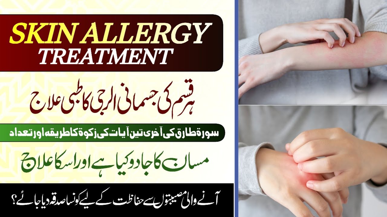 Skin Allergy Treatment Jismani Allergy Ka ilaj Masan Ka Jadu Kya