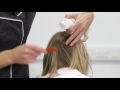 Treating scalp psoriasis