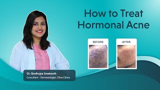 How to Treat Hormonal Acne | Hormonal Acne Treatment by Dr. Sindhujaa Sreekanth