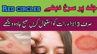 Rin worm treatment | Fungal infection treatment | psoriasis treatment 2024