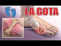 ¿Qué es la GOTA? 🦶🏼 ÁCIDO ÚRICO EN EL PIE 👣 DOLOR en el DEDO GORDO del PIE ✨ Dr CARLOS GLAVE TESTINO