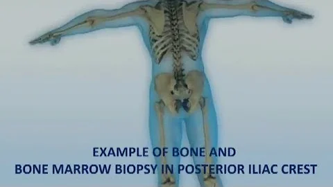 Jaká jsou rizika Biopsie jater?
