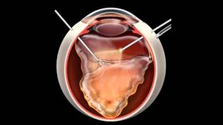 Retinal Detachment | Signs, Symptoms and Treatment