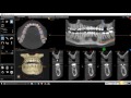 CS 3D Imaging - Tracé du canal mandibulaire