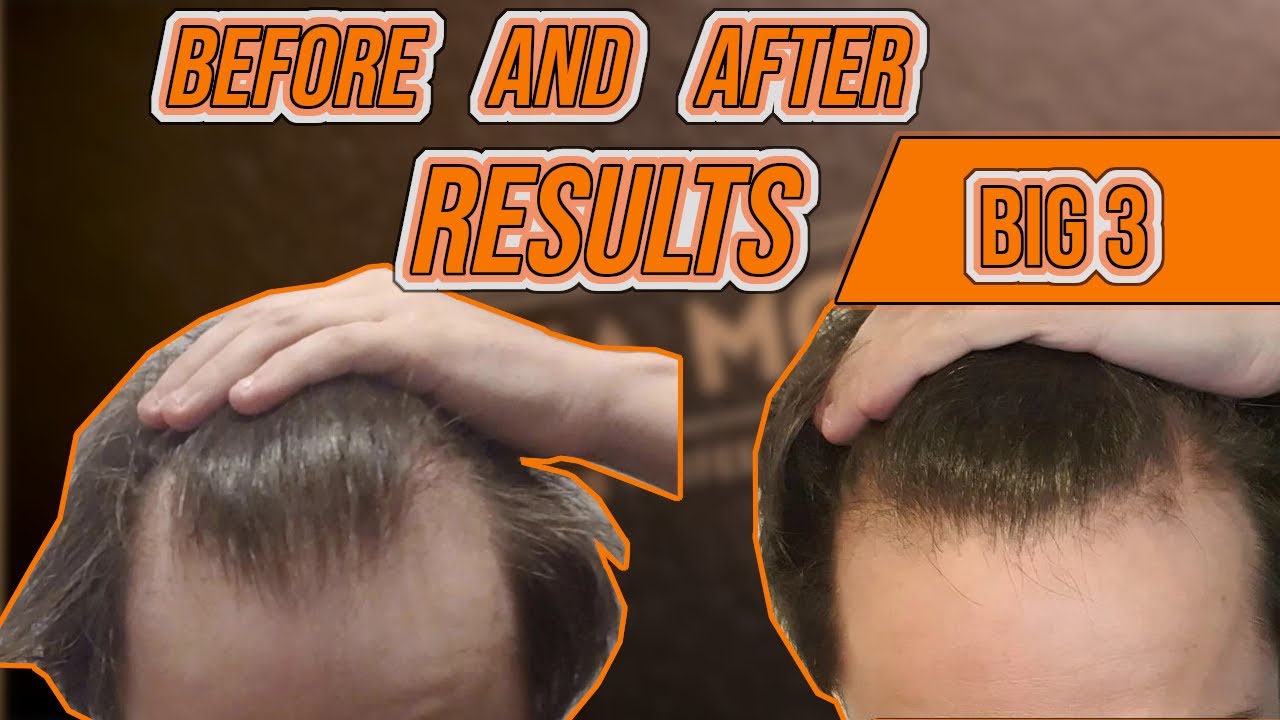 Finasteride, Minoxidil, Microneedling aka "The big 3" for hair loss