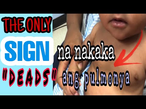 PULMONYA SA BATA| ang nakakatakot na senyales na nakakamatay ang UBO at mabilis na paghinga