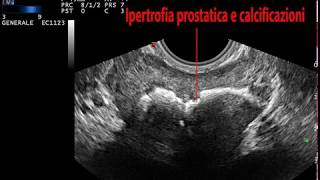 Krónikus prosztatitis kezelés mézzel Ha prostatitis van mit kell inni