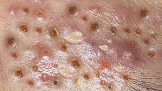 Loan Nguyen Acne Treatment 50b
