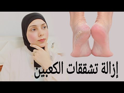 اسهل واسرع طريقه للتخلص من تشققات الكعبين تجربتي مع الشراب السيليكون تنعيم القدمين من اول استخدام