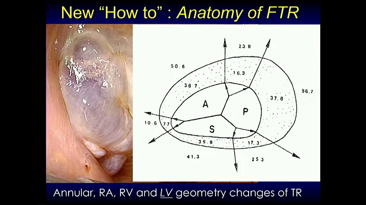 CVI 2019_Thursday 7/18_ Current Surgical Solutions for TR_Gorav Ailawadi, MD